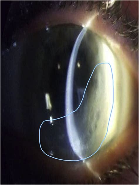 Acute corneal edema decades after penetrating keratoplasty for ...