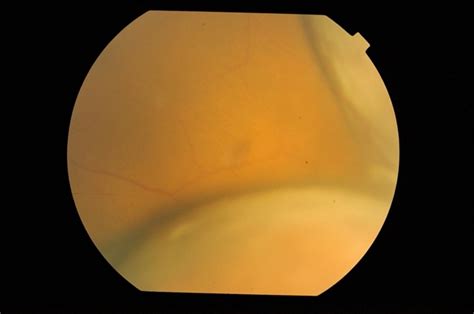 Uveitis With Exudative Retinal Detachment - Retina Image Bank