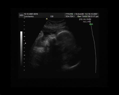 Ultrasound Of The Baby In A Stomach Of Mother Stock Footage Video 322927 | Shutterstock