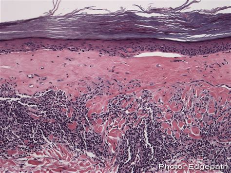 Medical Videos ppt and Lecture Notes: Lichen Sclerosus