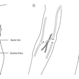 (PDF) Delayed Superficialization of Brachiobasilic Fistula: Technique and Initial Experience