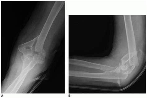 Distal Humerus Fractures | Musculoskeletal Key