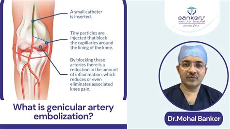 What is genicular artery embolization - YouTube