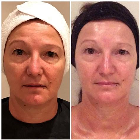 Thermage Before And After Photos Face (5) | Thermage, Facelift, Face