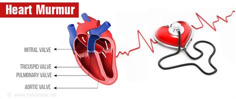 Heart/Cardiac Murmurs - Types Causes Symptoms Diagnosis Treatment ...