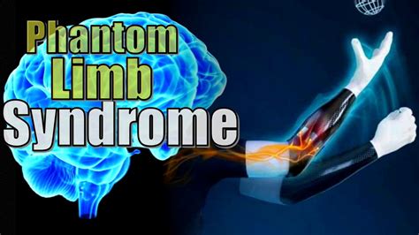 The Neural Maps of Phantom Limb Syndrome | What is it and how might it be cured in the Brain ...