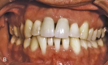 supragingival calculus formation and control | Chicago Criminal and Civil Defense