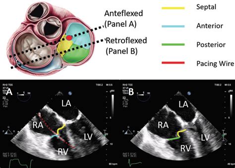 Imaging Considerations for Percutaneous Tricuspid Intervention - Cardiac Interventions Today