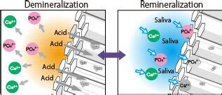 Calcium's Role in Teeth Remineralization and Demineralization - 1311 ...