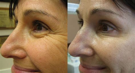 Wrinkle Treatment Before and After: Botox, Dermal Fillers