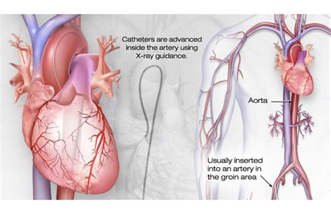 What is cardiac catheterization? - Medical Tubing and Extrusion