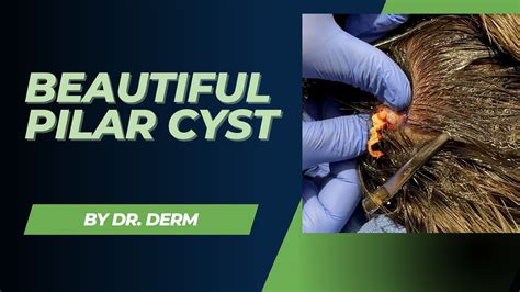 Beautiful Pilar Cyst | Dr. Derm - YouTube