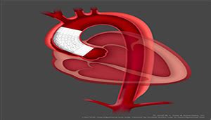 Gore tests stent graft for deadly heart condition - Medical Design and Outsourcing