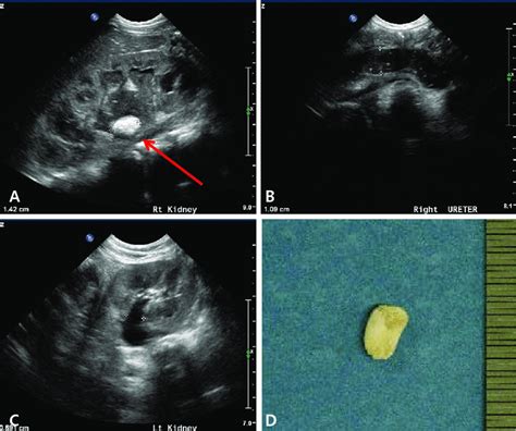 Kidney Stones Ultrasound