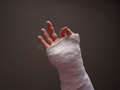 Injured hand with cast stock photo. Image of extremity - 19071014