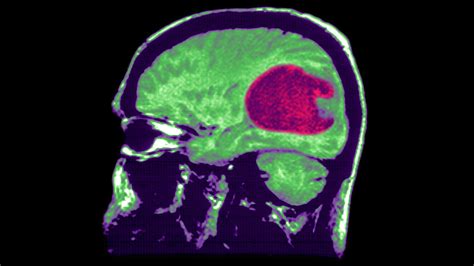 Glioblastoma symptoms, cause and treatment: More about the tumor that ...