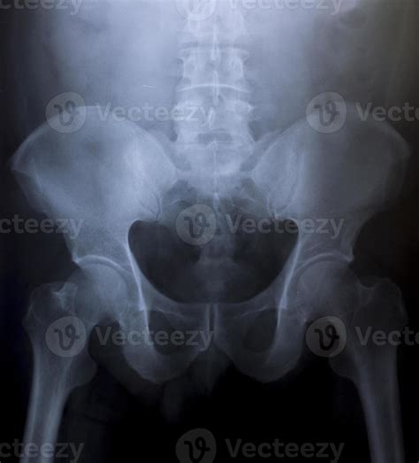 X-Ray Image Of Human Chest for a medical diagnosis 936897 Stock Photo at Vecteezy