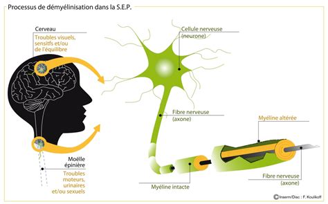 Multiple sclerosis: a composite treatment to repair damaged nerve fibres - Inserm Newsroom