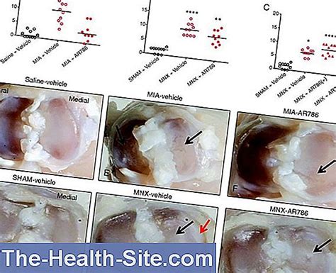 Chondropathy - Cartilage Erosion 💊 Scientific-Practical Medical Journal - 2023