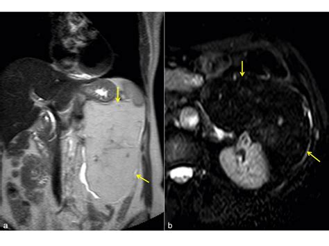 Giant Angiomyolipoma. MRI: Coronal T2-weighted (a) and STIR sequence ...