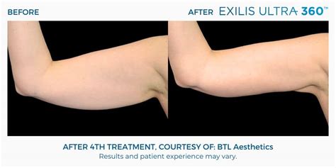 Exilis 360 Ultra El Paso | Exilis Skin Tightening Treatments