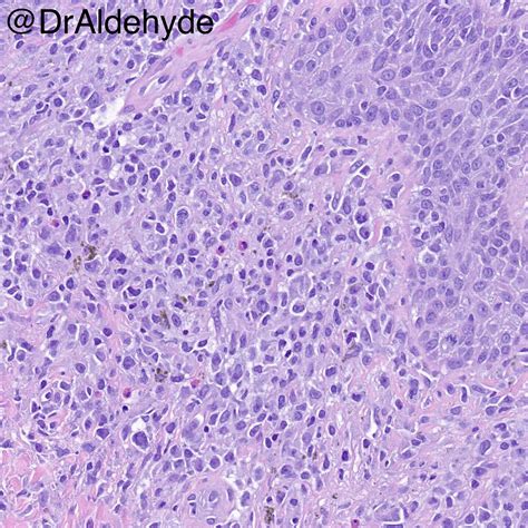 Mycosis Fungoides Histology