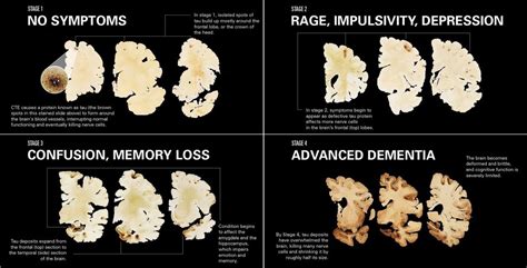 Chronic Traumatic Encephalopathy, a killer disease | SiOWfa16: Science ...