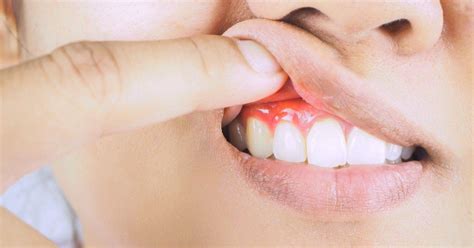 Gum Disease Stages | What Are the Symptoms of Gum Disease