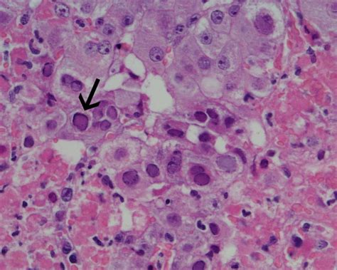 Pathology Outlines - Herpes simplex virus hepatitis