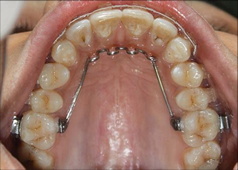 Mittal bonded tongue thrusting appliance - APOS Trends in Orthodontics