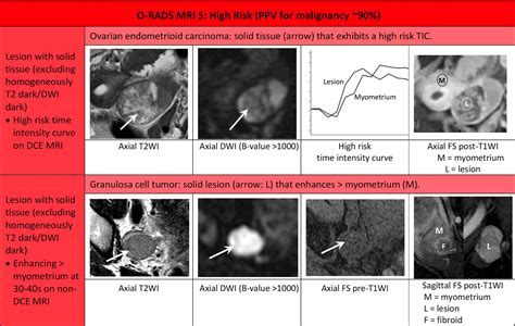 O-RADS MRI Calculator - RadioGyan