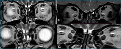 Olfactory Nerve Mri