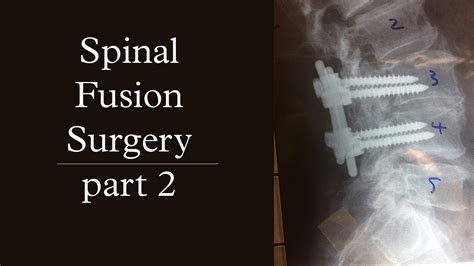 Spinal Fusion Surgery | pt. 2 - YouTube