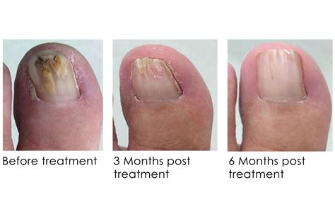 THE PODIATRY - Fungal nails