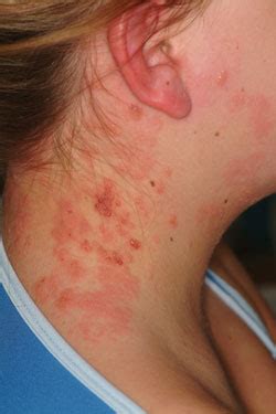 Adolescent female presents with painful rash on neck, ear | Infectious Diseases in Children