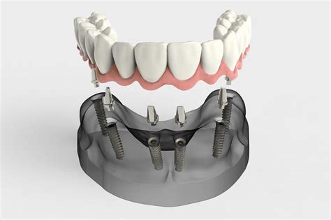 Implant-Supported Prosthesis: Types & Benefits | Locust Family Dentistry