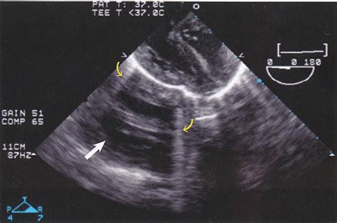 Pedi cardiology: Echo artifacts