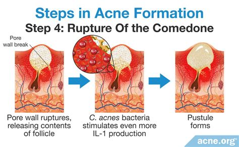 Scientists Now Believe Acne Is Primarily Inflammatory - Acne.org