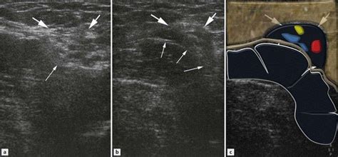 Normal inguinal canal, sagittal sonograms medial to the IEVs. (A) At rest, oval shaped inguinal ...