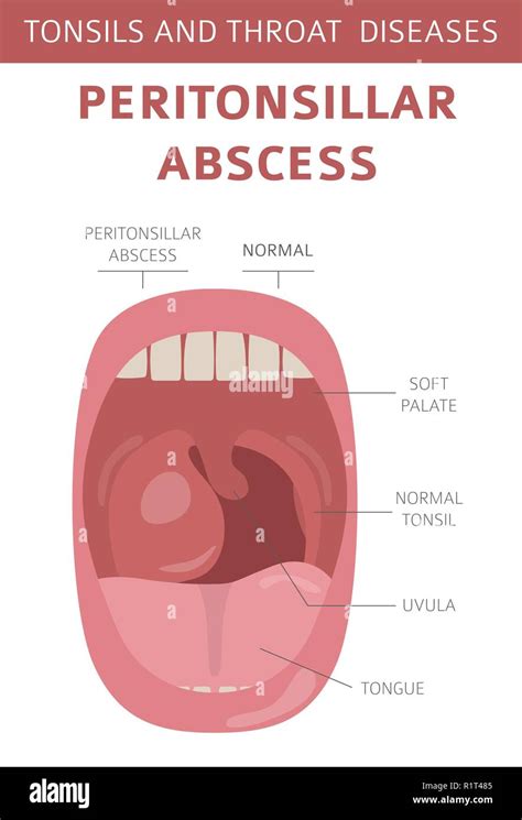 Uvulitis Explained: What's Causing Your Swollen Uvula?, 47% OFF