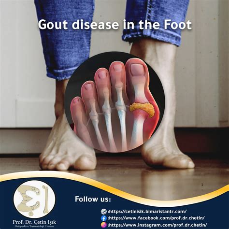 Everything you need to know about gout in the foot - Dr. What's wrong with you?