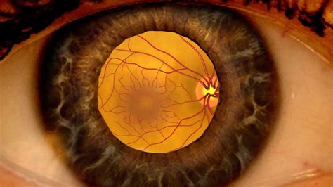 Animation: Detecting diabetic retinopathy through a dilated eye exam ...