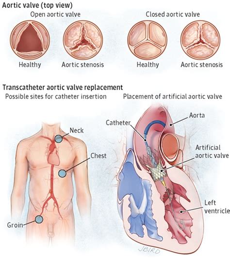 Aortic Stenosis | CORMedicalGroup.com