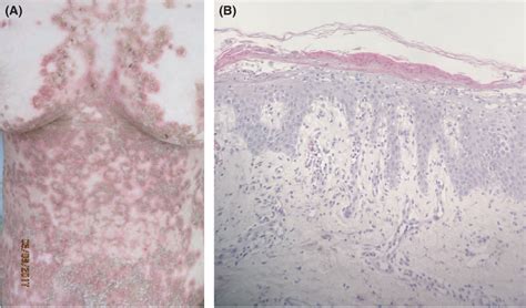 Figure 2 from A case of delayed diagnosis of Necrolytic Migratory ...