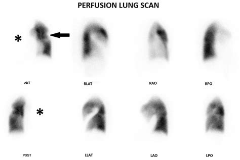 Frontiers | Pulmonary artery stenosis in Takayasu disease mimicking pulmonary embolism on ...