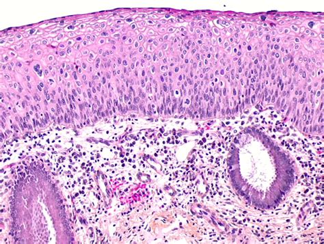 Histopathology and cytopathology of the uterine cervix - digital atlas - glossary