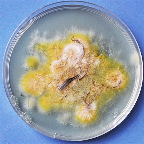 Recognition and treatment of dermatophytosis | Microseum