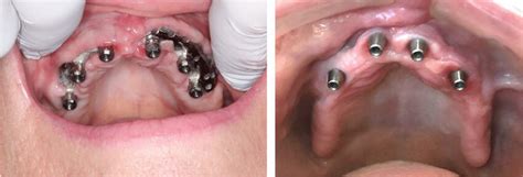 One of the 3 cases showing extensive wound dehiscence and exposure of ...