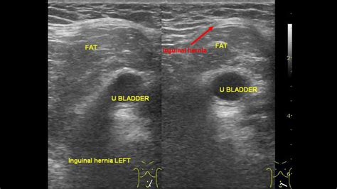 Inguinal hernia ultrasound - wikidoc