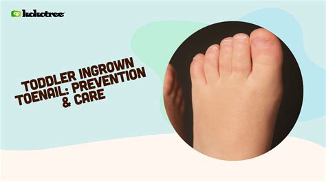 Toddler Ingrown Toenail: Prevention & Care - Kokotree